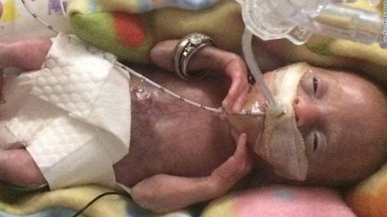 “Caso unico al mondo”: sopravvive bimba nata dopo 21 settimane dal concepimento, è un piccolo miracolo!